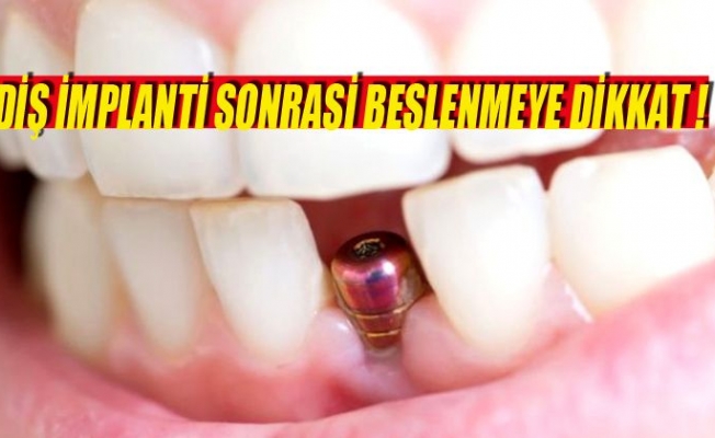 DİŞ İMPLANTI SONRASI BESLENMEYE DİKKAT !