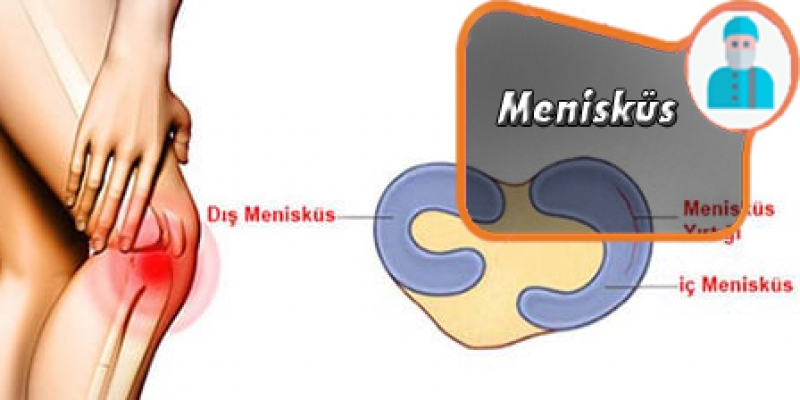 MENİSKÜS NEDİR ? BELİRTİLERİ NELERDİR ?